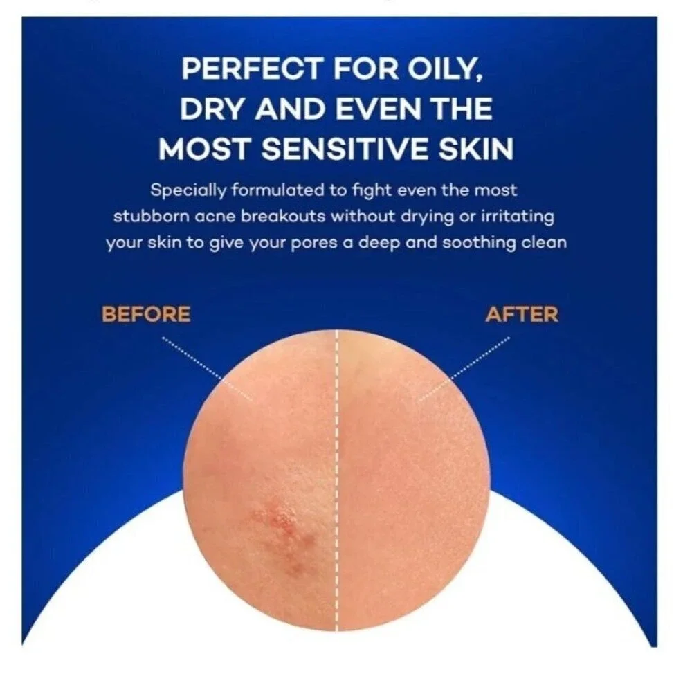 ZocuZap Acne Face Wipes Moisturizing Face Cleansing Wipes for Acne‎ Makeup B1